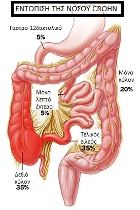 νόσος Crohn