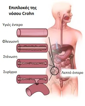 επιπλοκές νόσου Crohn