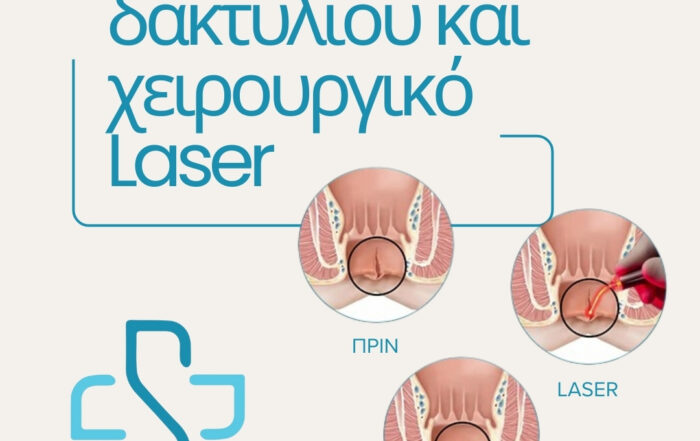 Ραγάδα δακτυλίου και χειρουργικό Laser