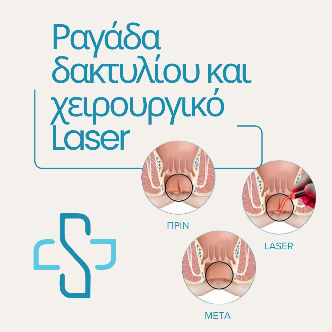 Ραγάδα δακτυλίου και χειρουργικό Laser