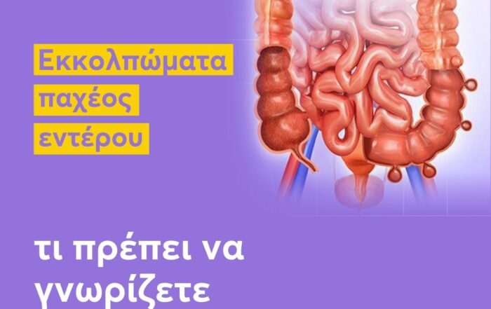 Εκκολπώματα παχέος εντέρου, τι πρέπει να γνωρίζετε;